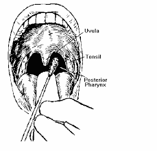 نمونه گیری با سواب نمونه گیری از حلق